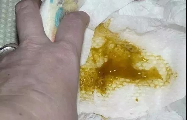 借卵供卵低费用生的宝宝大便有奶瓣和臭味（借卵供卵低费用生的宝宝大便有奶瓣味道酸臭）