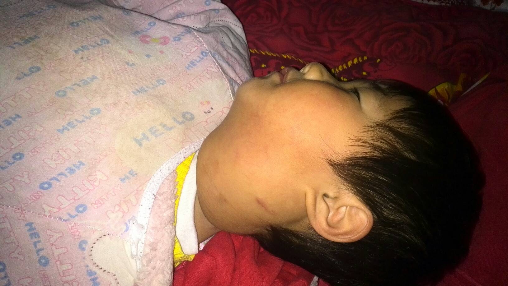 心得安治疗孕妈助孕服务生的婴儿血瘤（心得安治疗血管瘤前后图片）