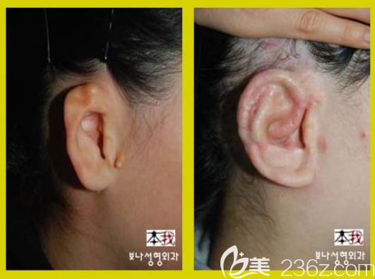 孕妈助孕服务生的婴儿耳朵畸形矫正医院（孕妈助孕服务生的婴儿耳朵畸形矫正医院挂什么科）