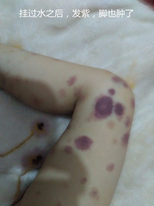 小代怀代生套餐生的孩子屁眼痒怎么回事（小代怀代生套餐生的孩子屁眼痒是什么原因呢）